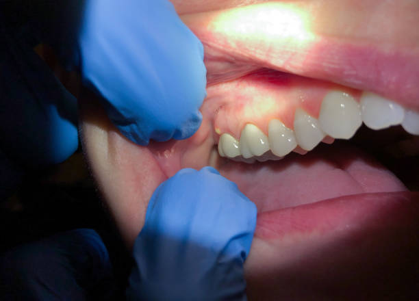 Best Emergency Dental Care for Broken or Chipped Teeth in Big River, CA