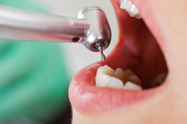 Best Emergency Tooth Extraction in Big River, CA